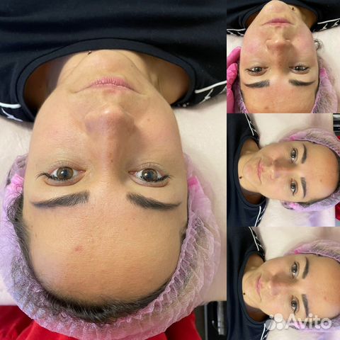 Смас лифтинг лицо тело Альтера