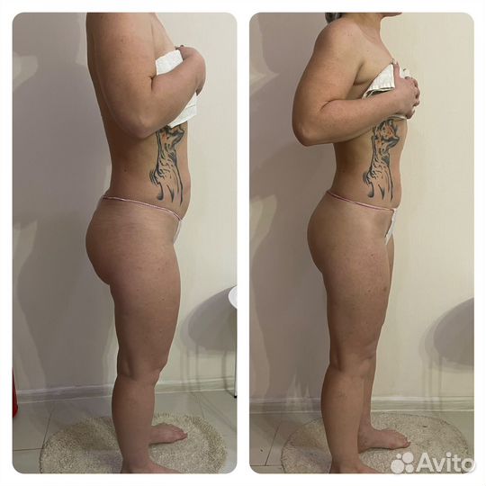 Аппаратный массаж