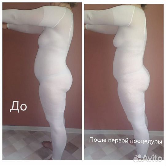 LPG массаж