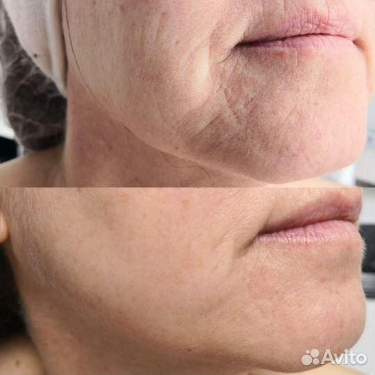 Ультразвуковая чистка лица