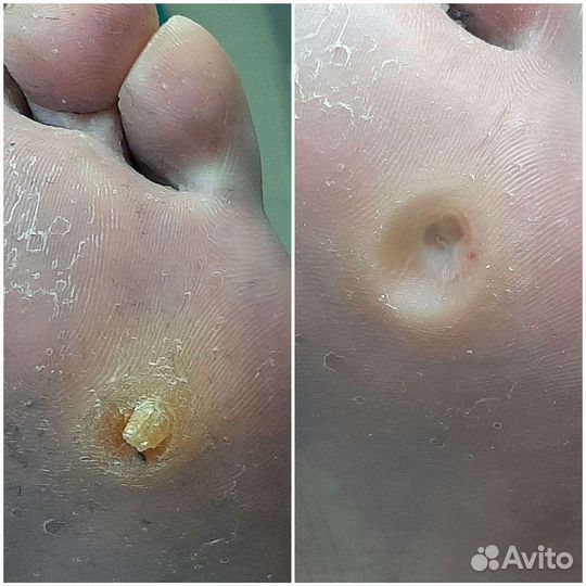 Подолог,педикюр,вросший ноготь