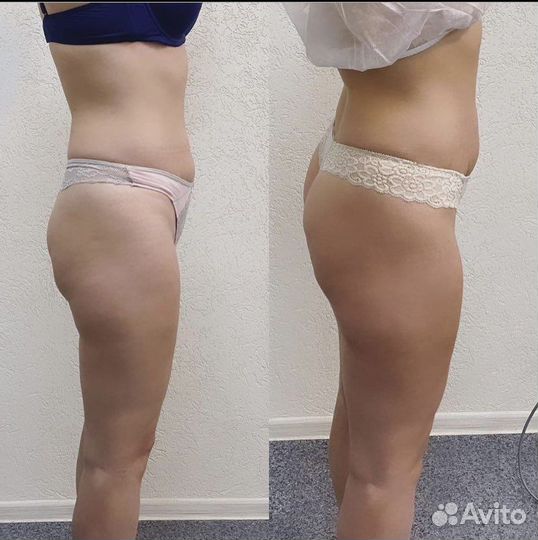 Антицеллюлитный массаж