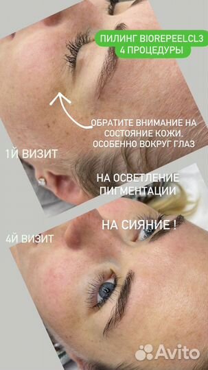 Комбинированная чистка лица