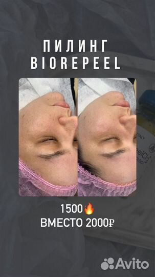 Пилинг Biorepeel