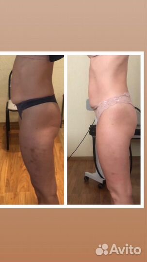 Процедура криолиполиз