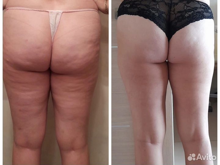 Коррекция фигуры Индиба Похудение