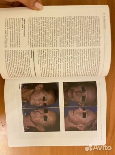 Инъекционные методы в косметологии 2018 Б. Ашера