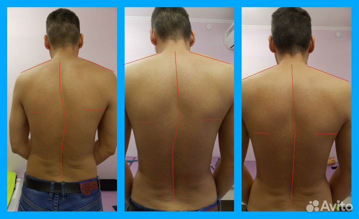 Массаж при сколиозе. Мануал и остеопатия