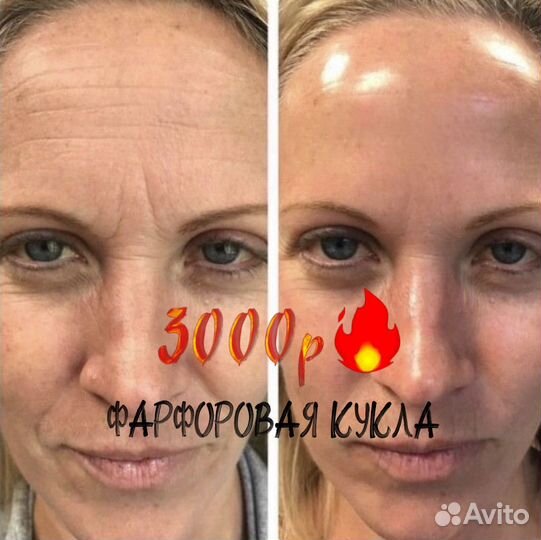 Мезоботокс