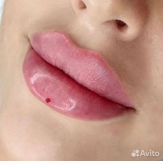 Контурная пластика, ботокс