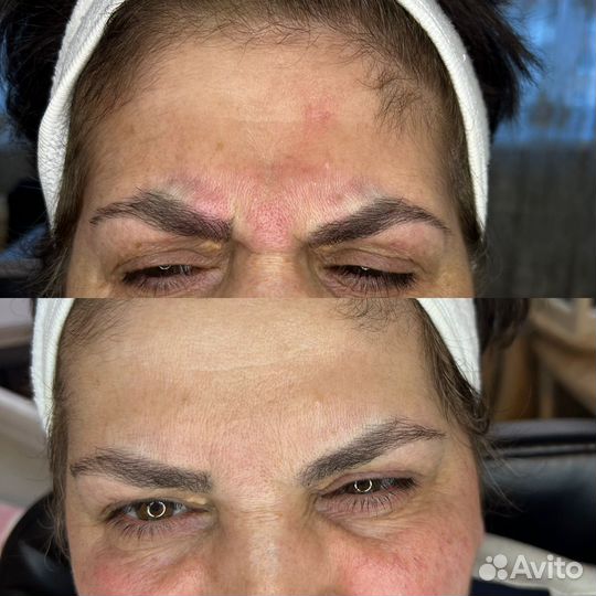 Уколы красоты