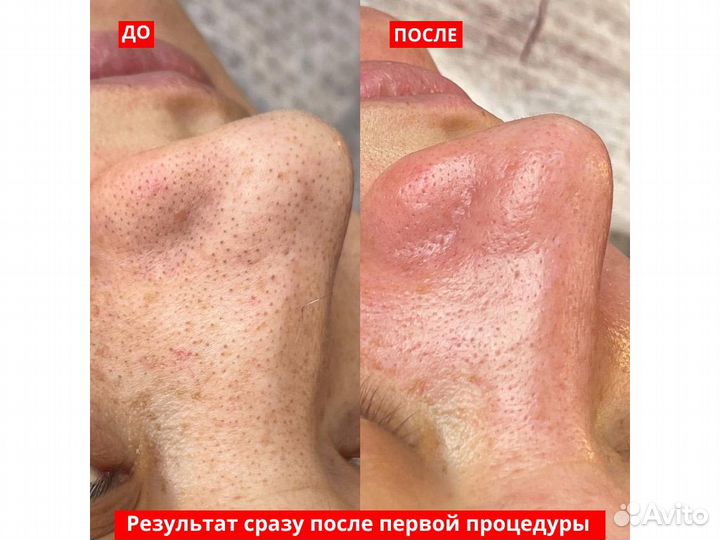 Чистка лица пилинг косметолог акне