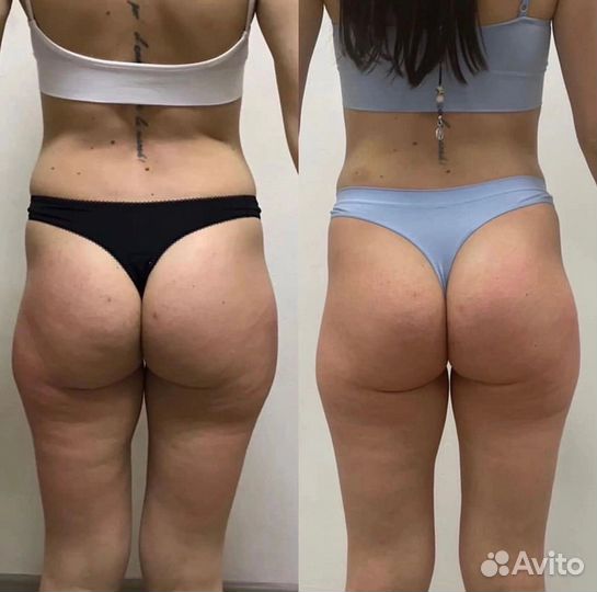 Аппаратный массаж (сфера терапия)