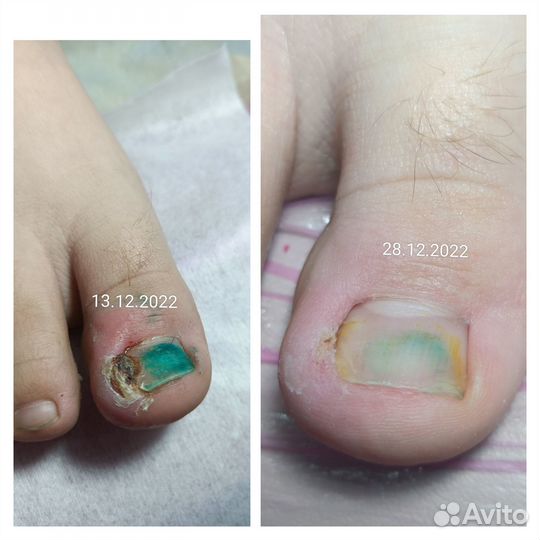 Подологический педикюр