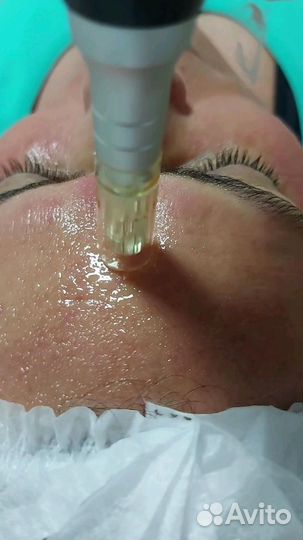 Hydrafacial,фракционая меза лица,тела,головы,рук