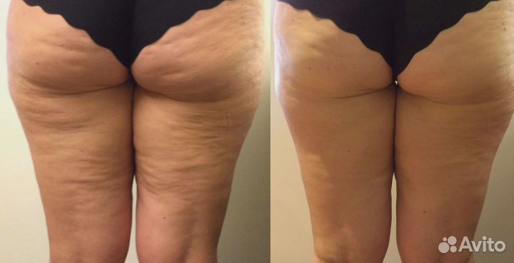 LPG Массаж и Косметология