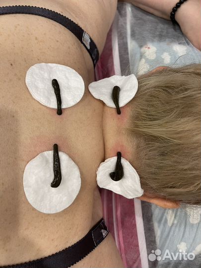 Купон на гирудотерапию