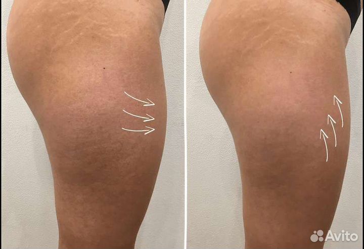 Lpg массаж, уз кавитация, РФ лифтинг и т. д