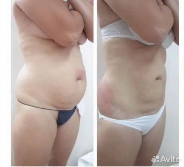 Модель на криолиполиз