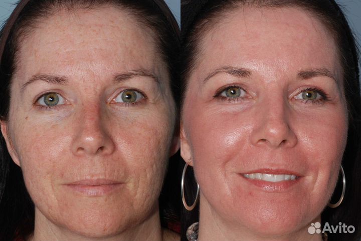 Модели на Гликолевый Пилинг (бесплатно)