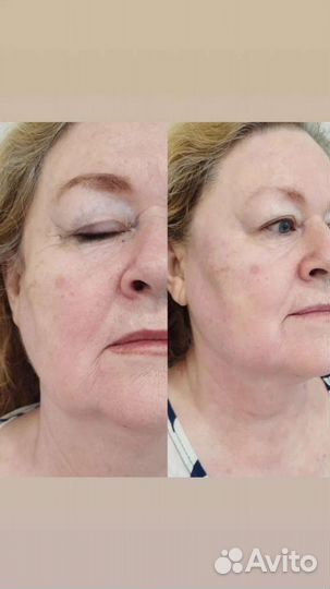 Смас-лифтинг Ультраформер