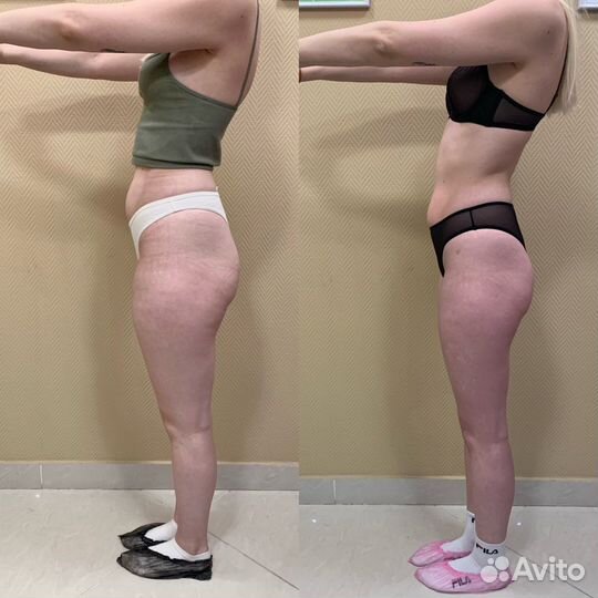 Массаж LPG лица и тела