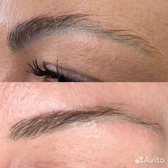 Удаление татуажа и тату лазером требуются модели