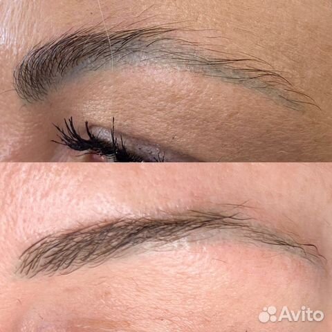 Удаление татуажа и тату лазером требуются модели