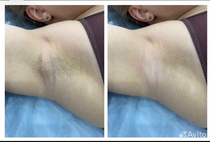 Депиляция воск/шугаринг