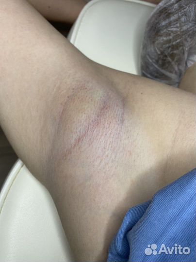 Шугаринг, депиляция воском