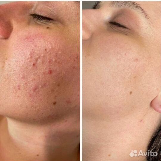 Карбоновый пилинг лица -50%