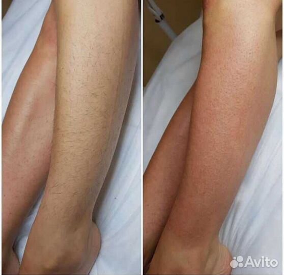 Косметолог эпиляция
