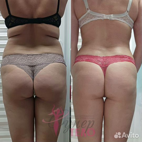 Кавитация/Вакуумный массаж/Коррекция фигуры