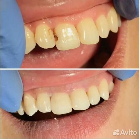 Пломба на зуб