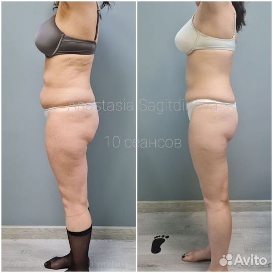 Антицеллюлитный массаж vela shape, LPG, вакуумный