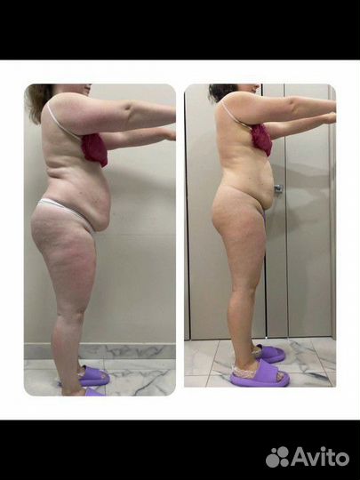 Аппарат для подтяжки овала лица и липосакции тел