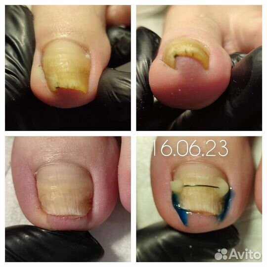 Педикюр, титановая нить, протезирование ногтей