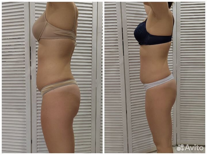 LPG (вакуумно-роликовый массаж),мадейратерапия