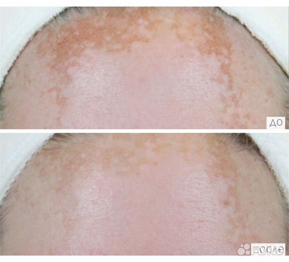 Пилинг скинбрайт dermaquest - набор на 4 процедуры