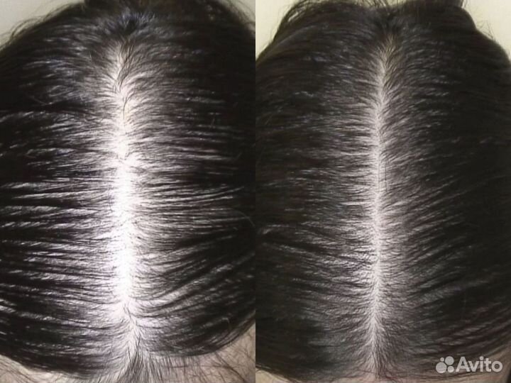 Лечение волос / пилинг / трихолог