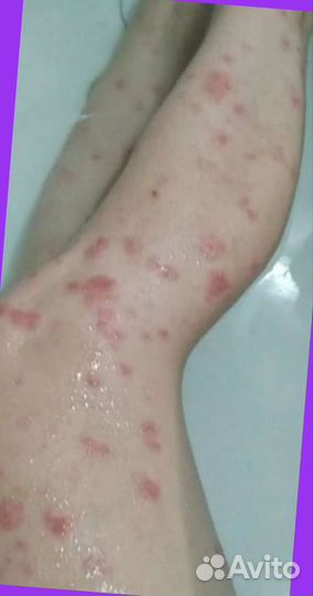 Мазь от псориаза