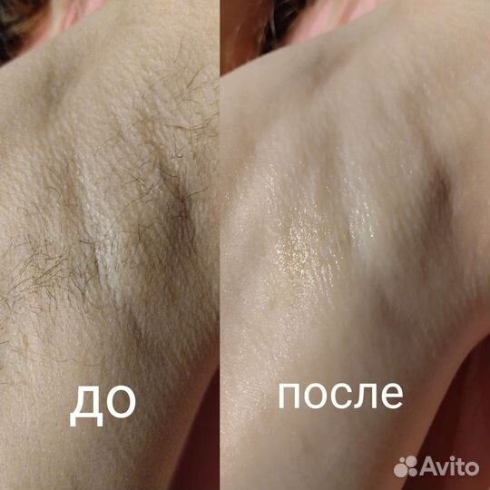 Шугаринг