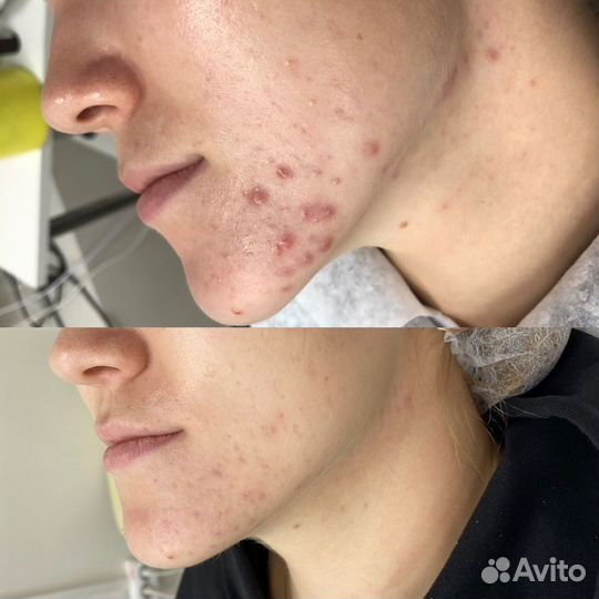 Чистка лица