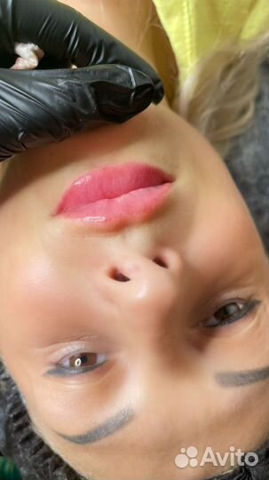 Увеличение губ