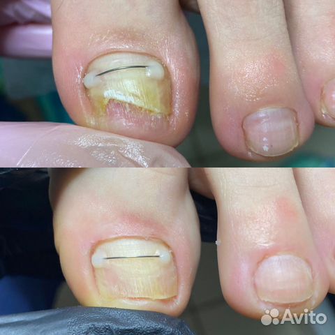 Подолог. Вросший ноготь. Титановая нить