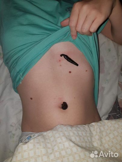 Пиявки медицинские