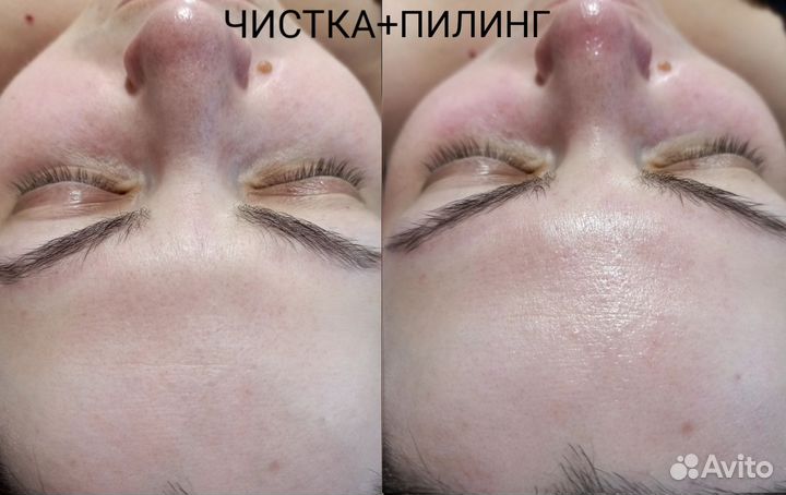 Чистка лица