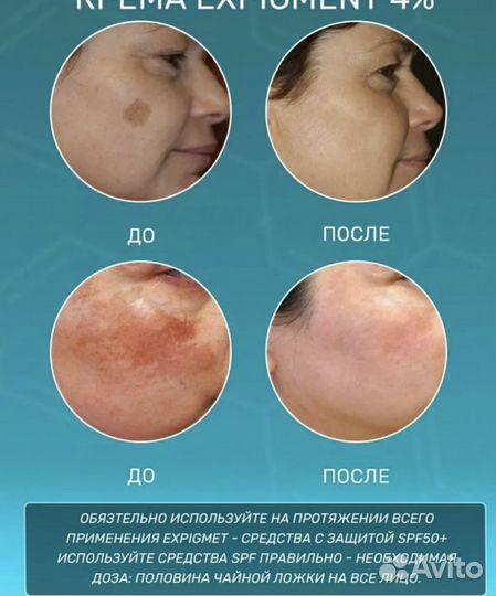 Крем от пигментации Expigment 4