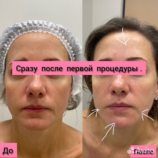 Омоложение лица