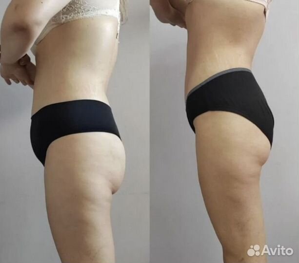 Антицеллюлитный массаж / LPG аппаратный массаж